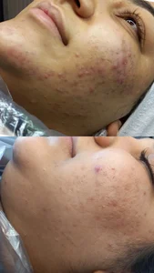 فیشال و پاکسازی پوست مرضیه صالحی 3