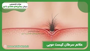 علائم سرطان کیست مویی: راهنمای تشخیص و درمان - مرکز تخصصی درمان ...