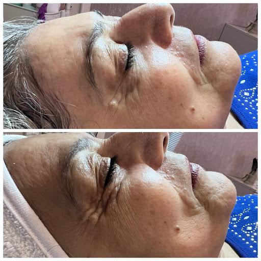 پاکسازی پوست شادی
