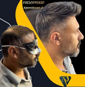 مرکز تخصصی پروتزمو و ترمیم مو(ایرانمو)اصفهان 4