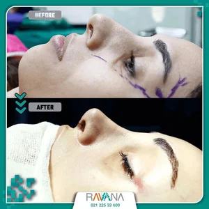 امبدینگ لاغری کلینیک کرج