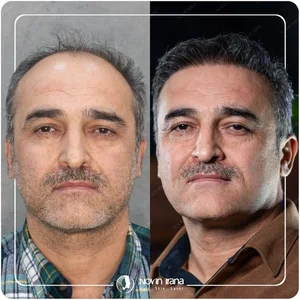 کاشت مو چیست؟ چگونه انجام می‌شود؟