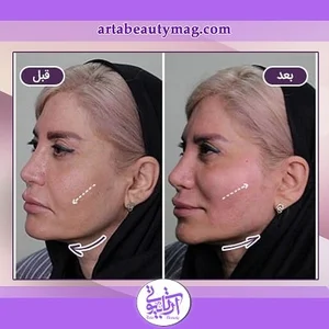 فیشال پوست