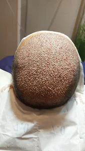 کاشت تخصصی موی طبیعی شهلا