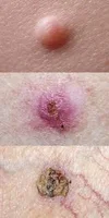 Basal Cell Carcinoma (BCC) Skin Cancer Risk Factors & Treatment | Saint  John's Cancer Institute