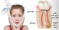 انواع درد دندان (علت درد دندان ) | دکتر مریم حاجی احمدی