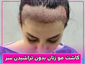 کاشت مو زنان| بهترین روش های کاشت مو برای خانم ها+ عکس قبل و بعد ...