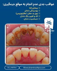 قیمت جرم گیری دندان 1404 | جدول هزینه + مشاوره رایگان