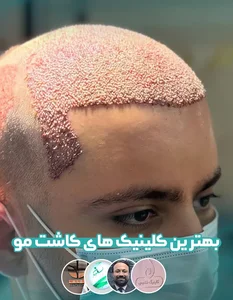 کلینیک کاشت مو میکامو