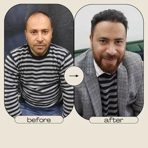 کاشت تخصصی موی طبیعی شهلا 4