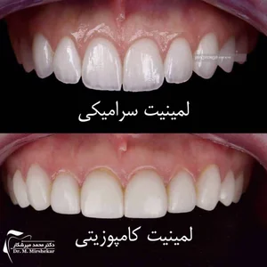 لمینت یا کامپوزیت | دکتر میرشکار