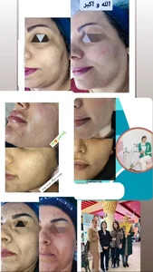 آموزش و انجام پاکسازی تخصصی پوست نیلوفر 2