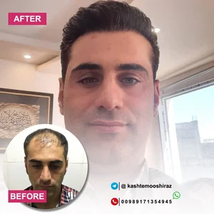 مرکز کاشت مو حسینی 2