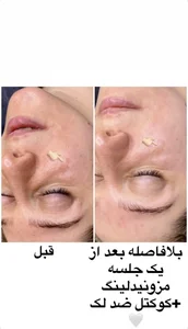فیشال و پاکسازی پوست حنانه وقاری 2
