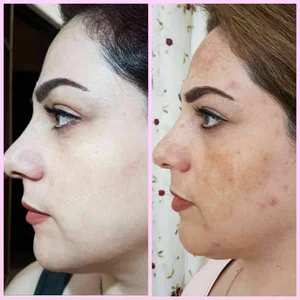 زیبا شو با من تضمینی لک صورت و کک و مک 3