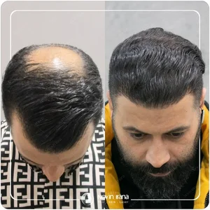 کاشت مو چیست؟ چگونه انجام می‌شود؟