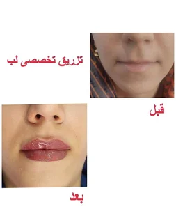تزریق ژل و بوتاکس در شرق