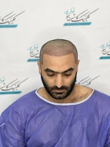 کاشت مو نوذرپور