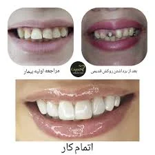 لمینت دندان چیست و چگونه انجام می‌شود؟ - ایمپلنت دندان،‌ متخصص ...