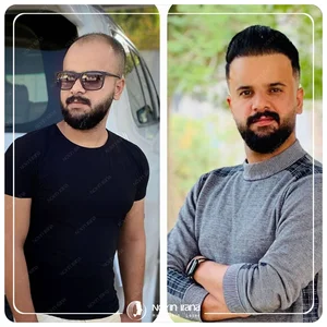 کاشت مو لیان