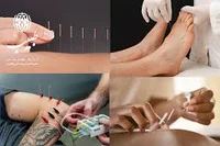 طب سنتی و تل گیری