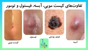 کیست مویی (سینوس پیلونیدال) چیست؟ | مراقبت‌ها، هزینه و لیزردرمانی ...