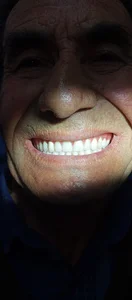دندانسازی الماس