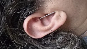 Silver.acupuncture طب سوزنی نقره