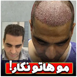 ۱۵ اشتباه رایج در کاشت مو + راه حل ها – کلینیک کاشت مو VIP ...