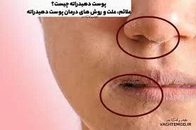 پوست دهیدراته چیست؟علائم، علت، روش های درمان پوست دهیدراته