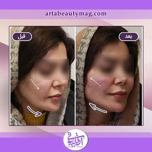خدمات زیبایی تزریق ژل و بوتاکس شاهمرادی