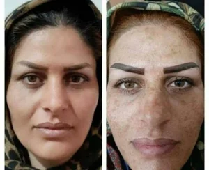 زیبا شو با من تضمینی لک صورت و کک و مک 2