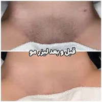 لیزر موهای زائد
