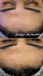 فیشال و پاکسازی پوست حنانه وقاری 3