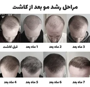 مراحل رشد مو بعد از کاشت | بعد از کاشت مو چه اتفاقی می افتد ...