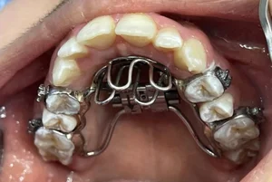 لابراتوار تخصصی ارتودنسی حبیبی (سازنده تخصصی اورال اپلاینس یا دستگاه دهانی خروپف) 3