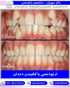 نمونه درمان ارتودنسی | عکس های قبل و بعد از انجام ارتودنسی دندان ...