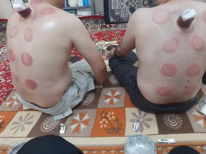 حجامت درمانی 4