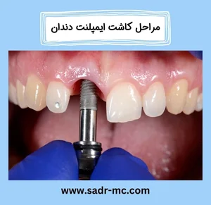 مرکز تخصصی جراحی لثه،دندان و ایمپلنت دکتر هوشیار