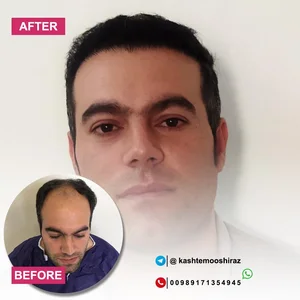 مرکز کاشت مو حسینی