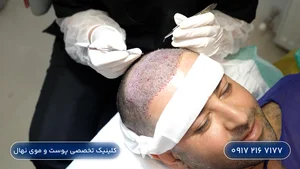 ترمیم مو و پروتز مو ایندرا